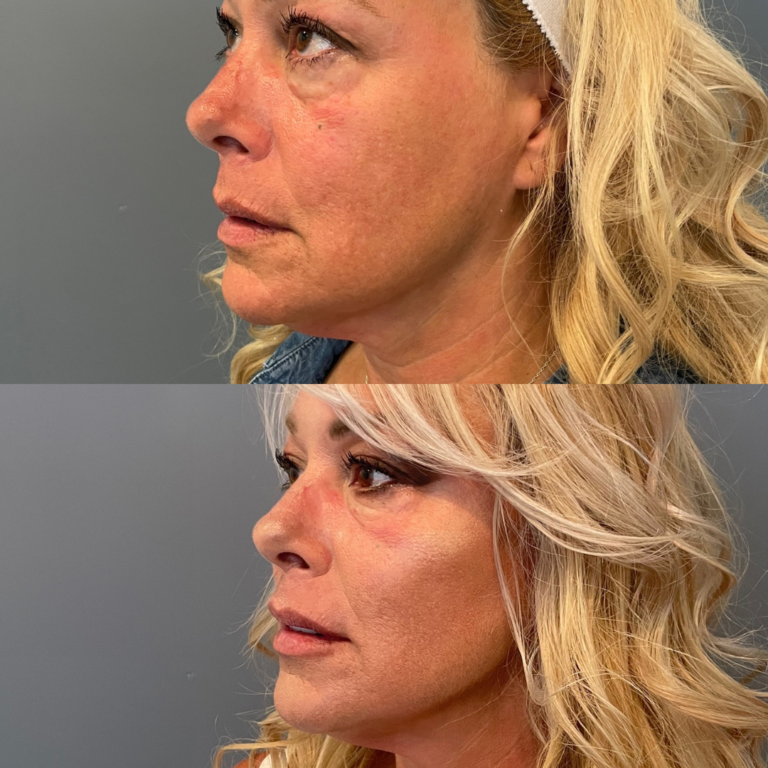 vero beach patient before and after cheek filler and pdo thread lift at align aesthetics