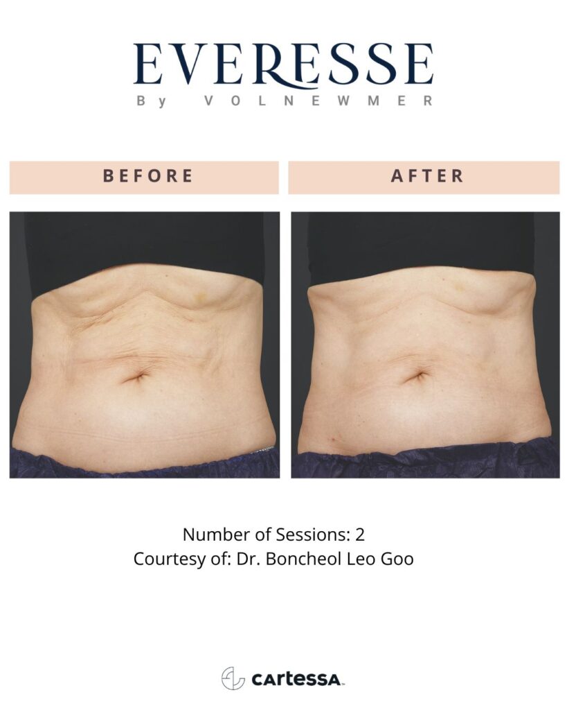 everesse vero beach stomach skin tightening