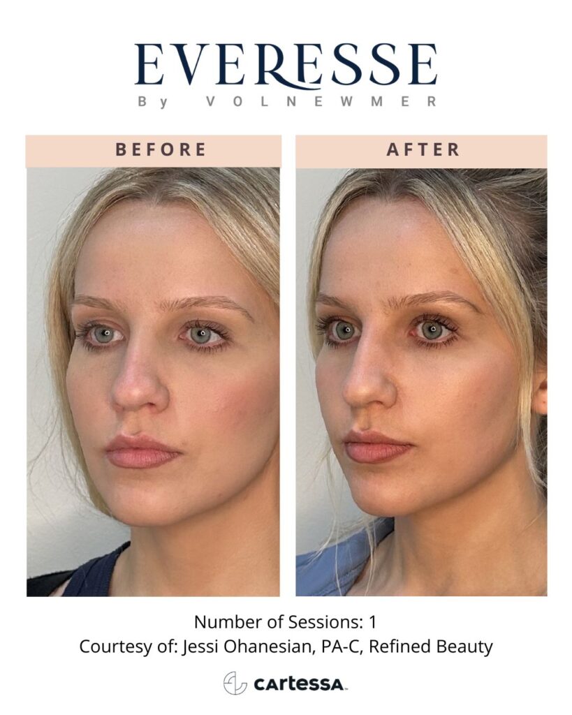 vero beach jawline med spa double chin everesse skin tightening