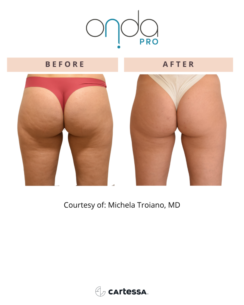 Onda Pro before and after cellulite reduction on the back of thighs and glutes in vero beach fl