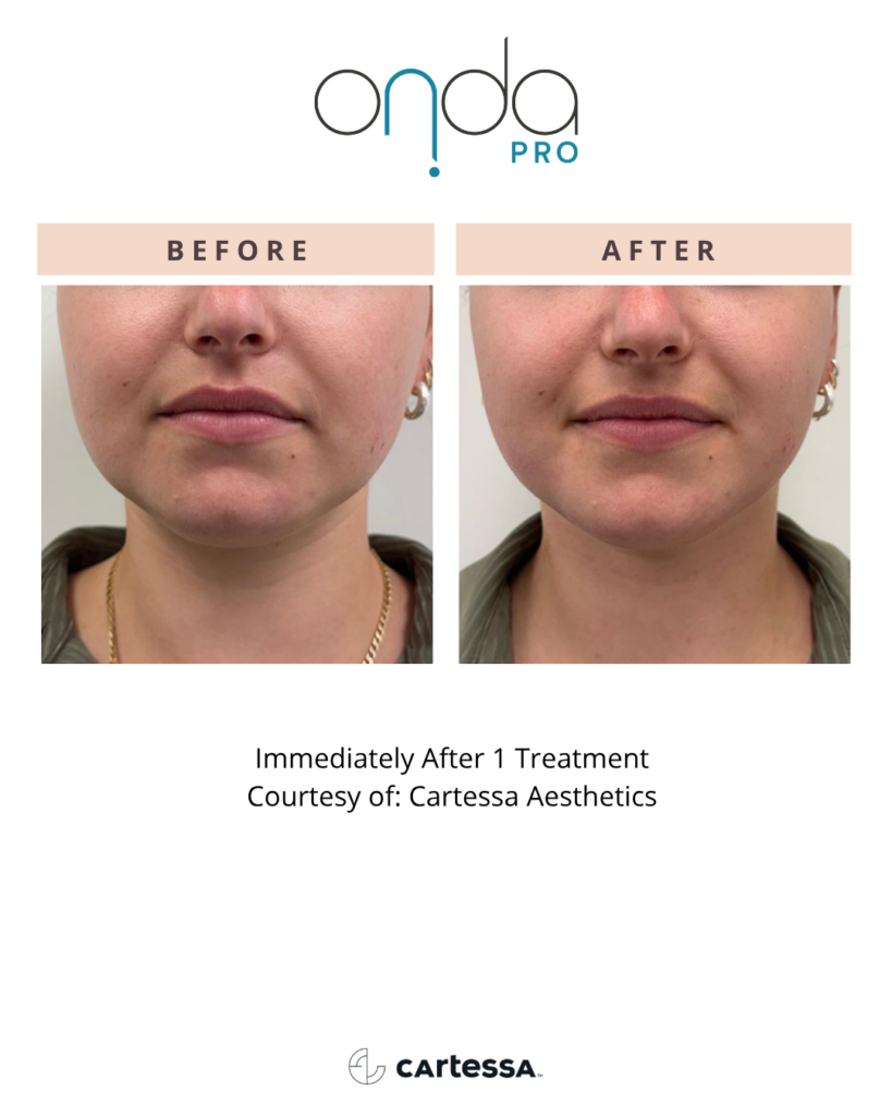vero beach patient before and after face contouring with onda pro laser