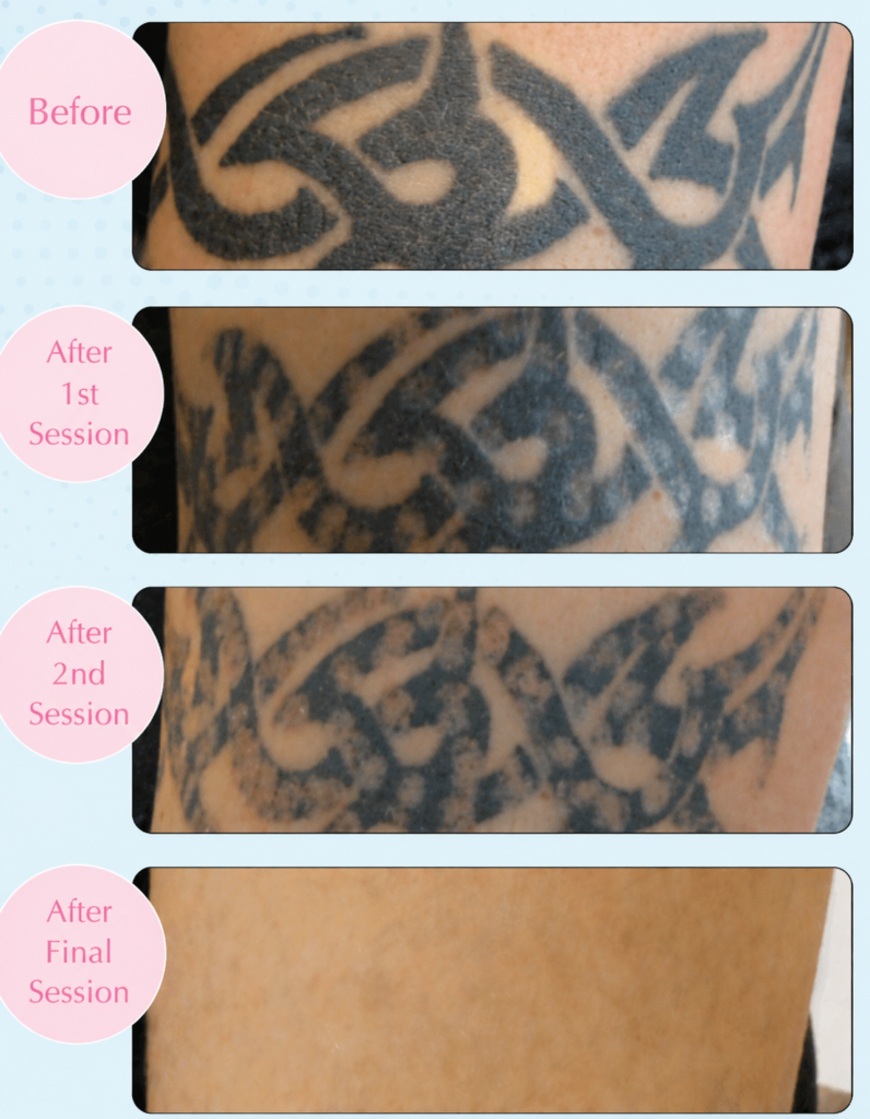 vero beach patient shown before and after 3 sessions of ink out tattoo removal treatment