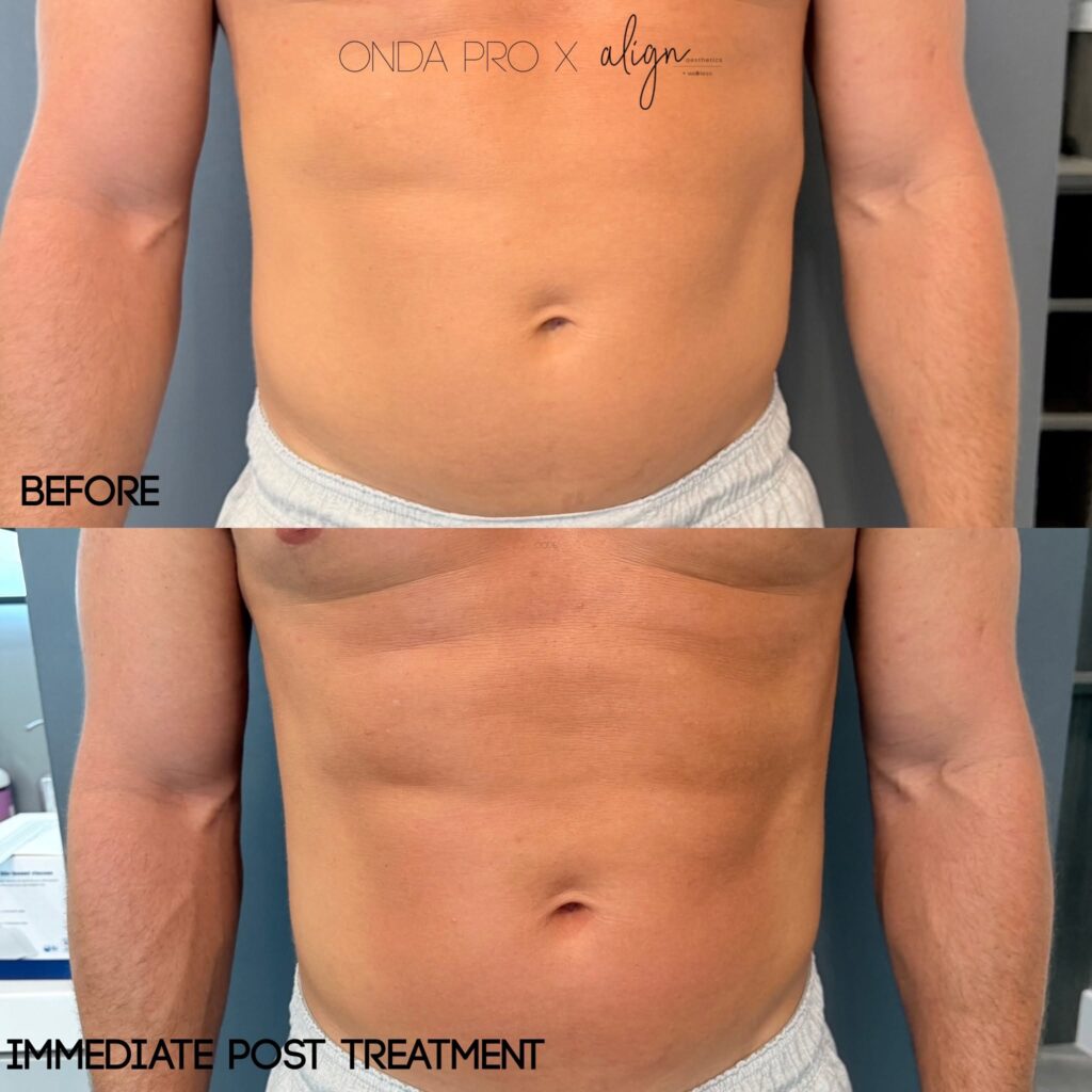 vero beach patient before and after onda pro body contouring on tummy at align aesthetics
