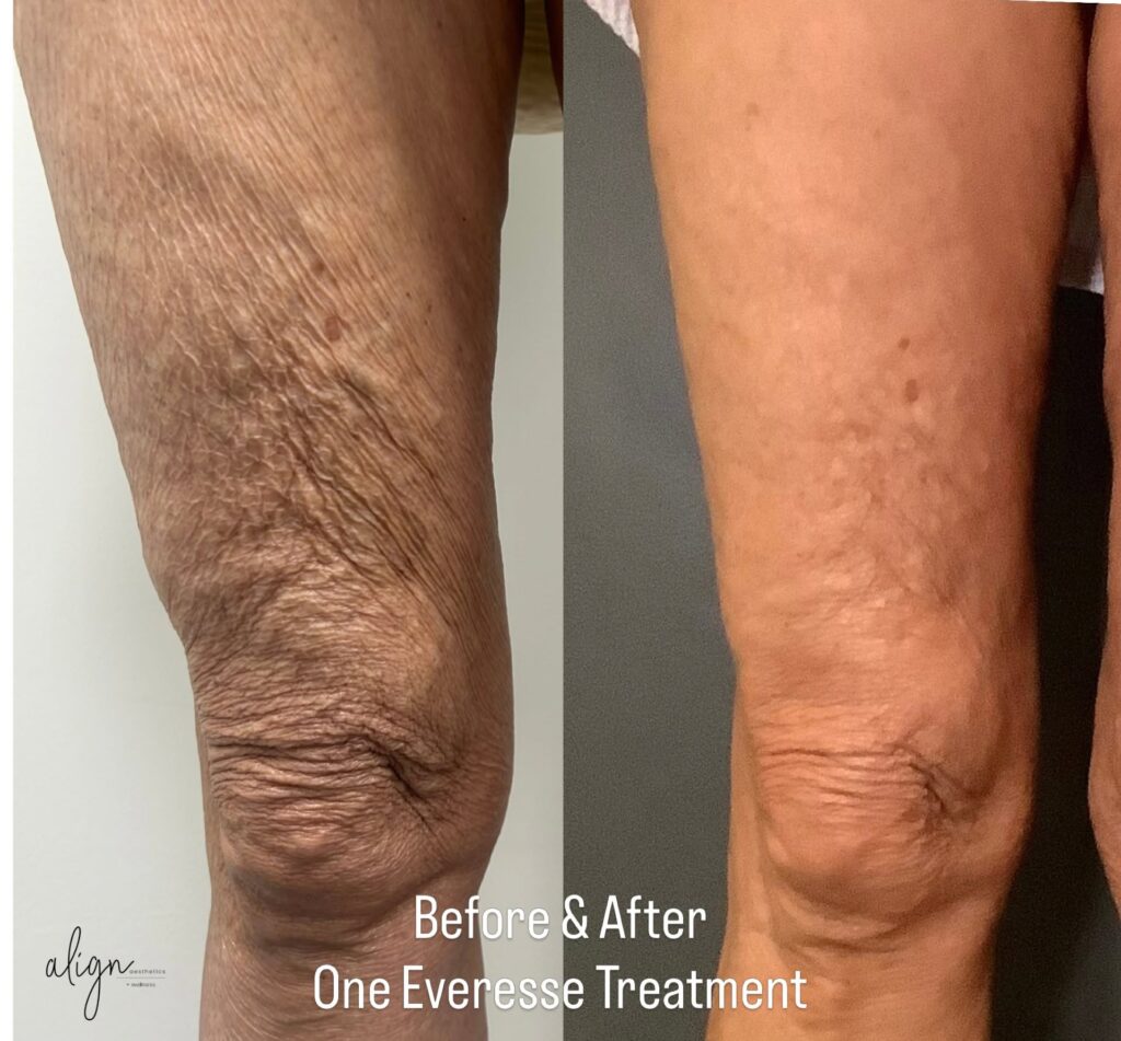 vero beach patient before and after everesse rf skin tightening on knees and legs at align aesthetics med spa