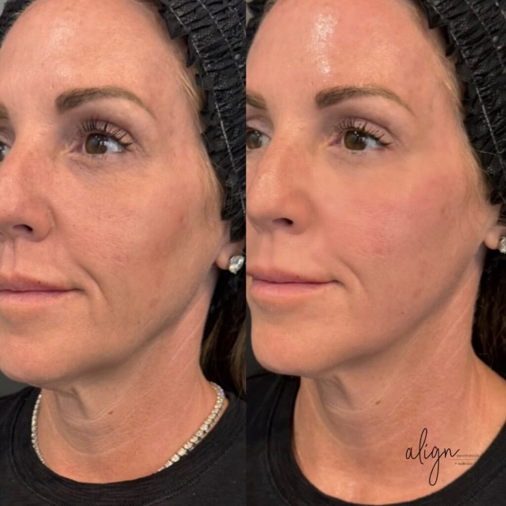 vero beach patient before and after everesse skin tightening on face and neck at align aesthetics