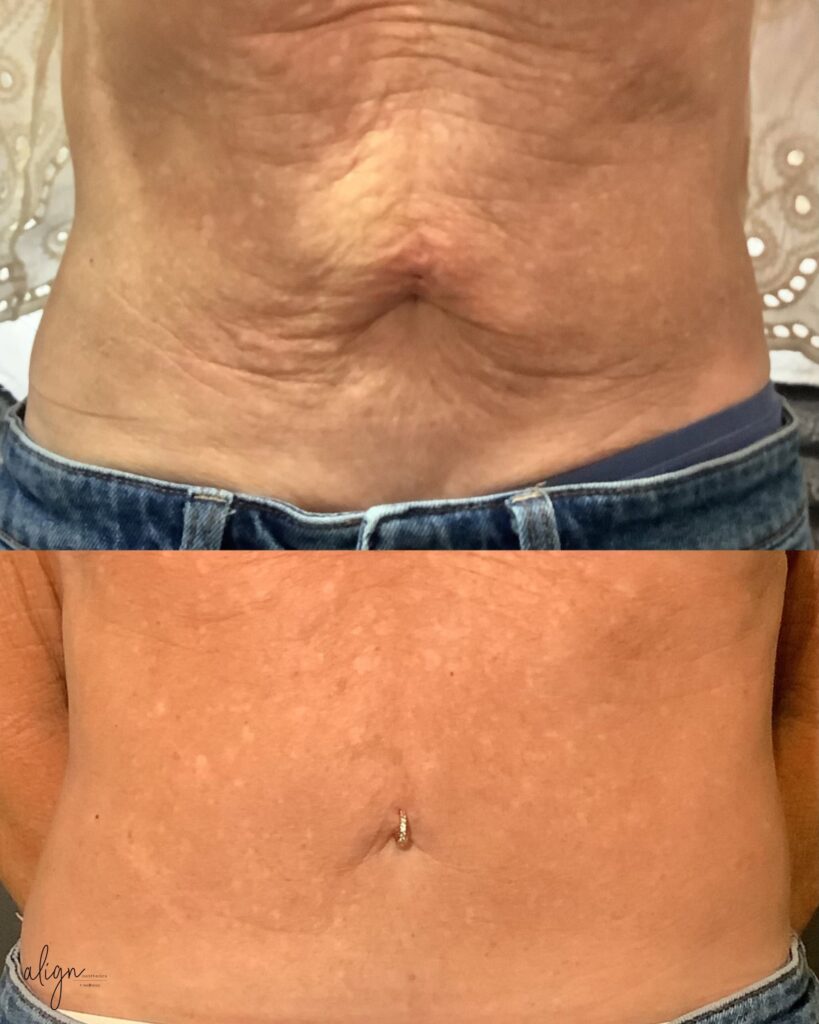 VERO BEACH PATIENT BEFORE AND AFTER EVERESSE SKIN TIGHTENING ON STOMACH