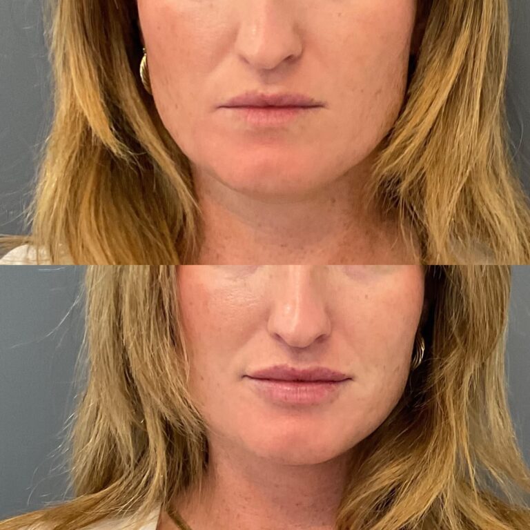 vero beach patient before and after lip filler at align aesthetics med spa