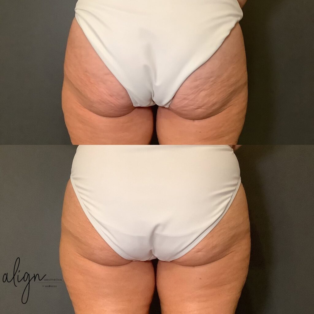 vero beach patient before and after cellulite treatment with onda pro at align aesthetics