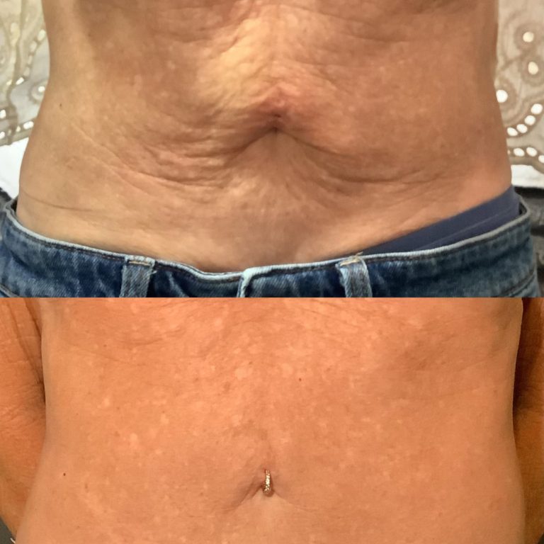 VERO BEACH PATIENT BEFORE AND AFTER EVERESSE SKIN TIGHTENING ON STOMACH